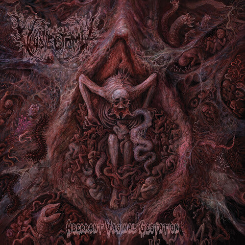Vulvectomy- Aberrant Vaginal Gestation (CD)-Track Cache
